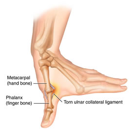 Have I Got A Thumb Ligament Injury Manchester Hand Wrist Surgery