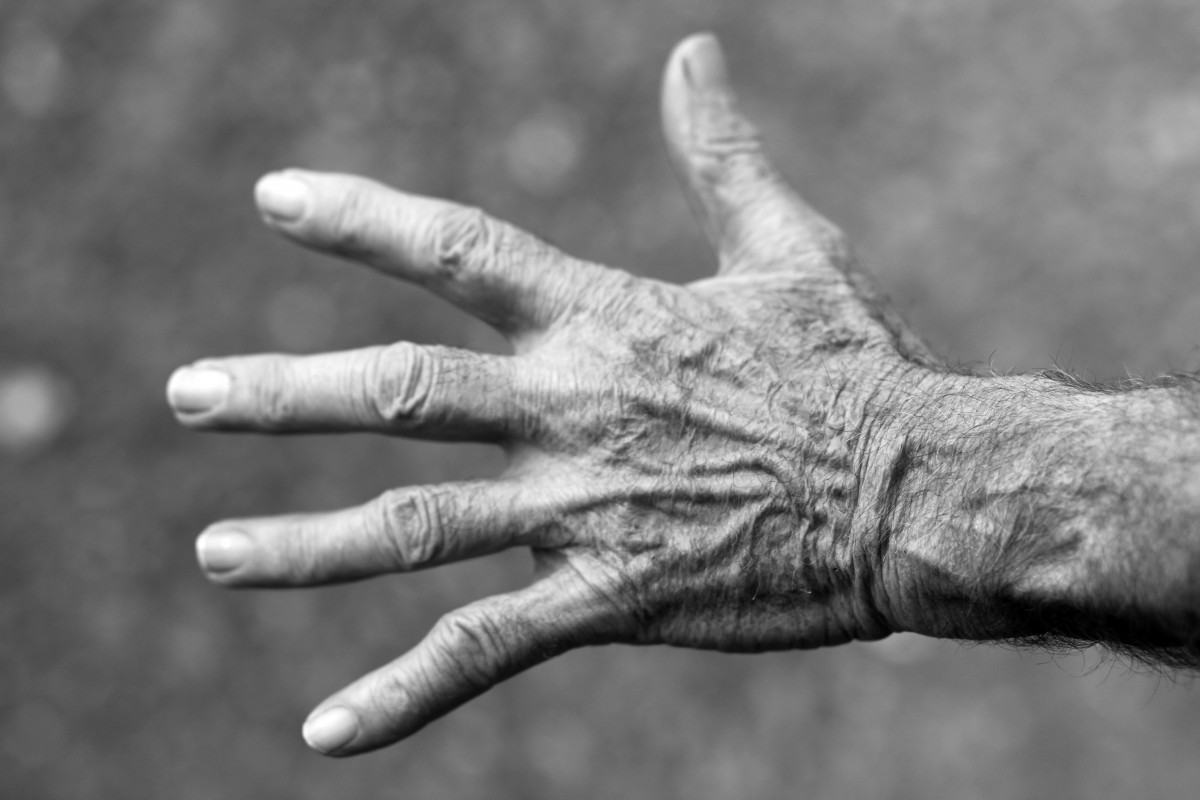 Rheumatoid finger arthritis