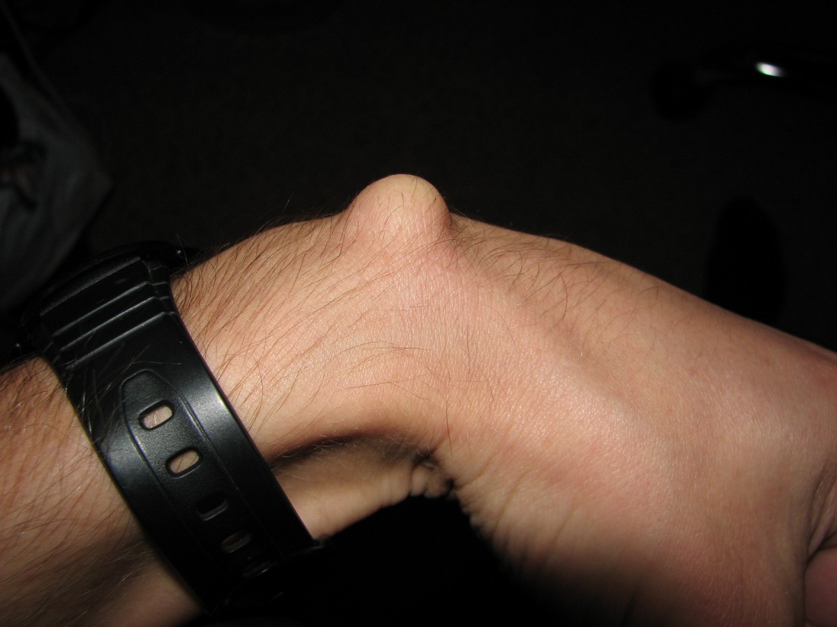 Ganglion Cyst on the wrist