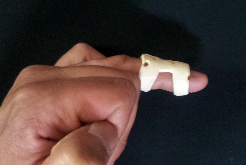 Mallet finger in a splint