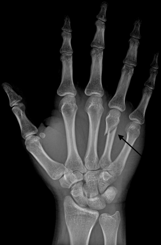 Broken metacarpal bone