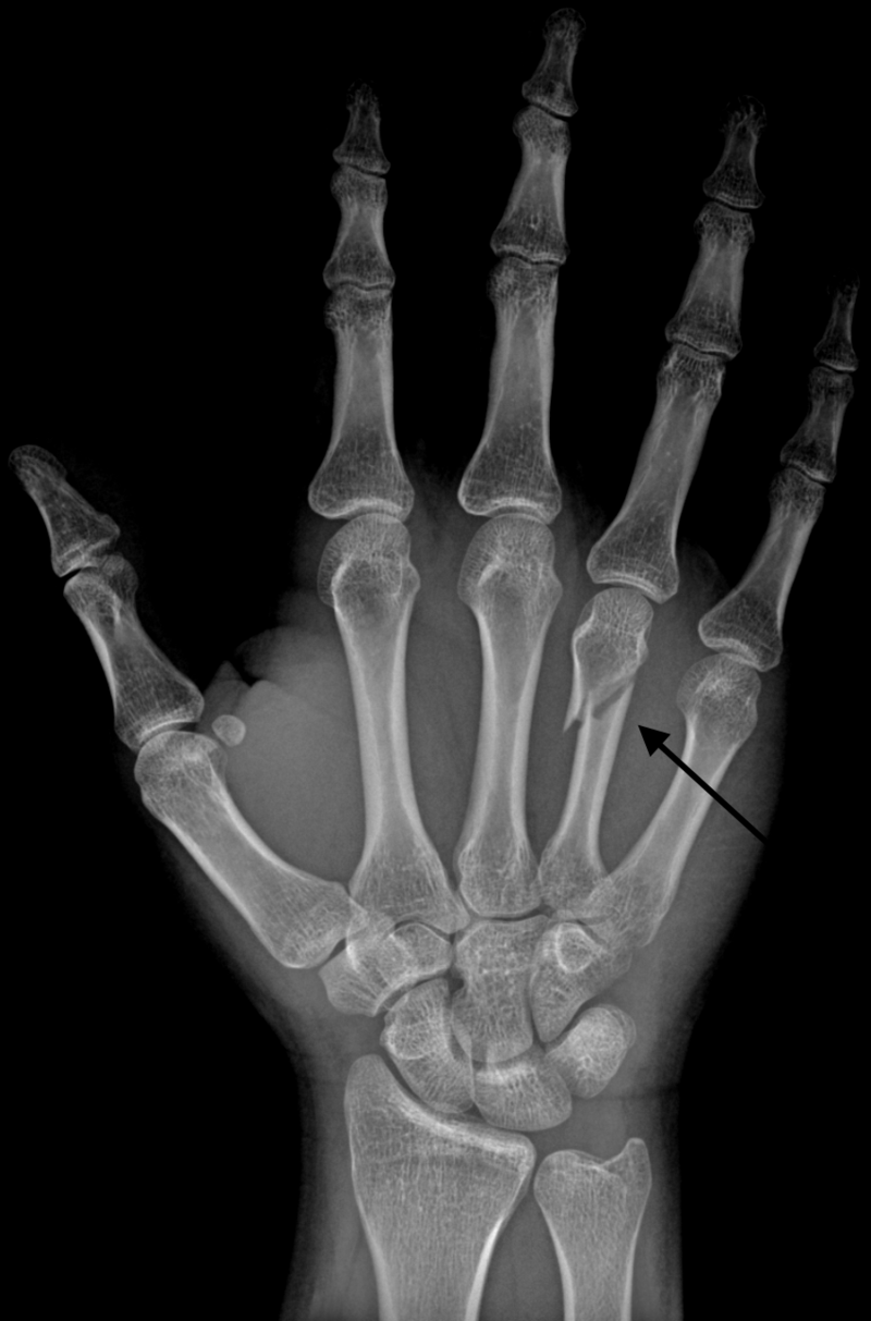 5th metacarpal fracture surgery