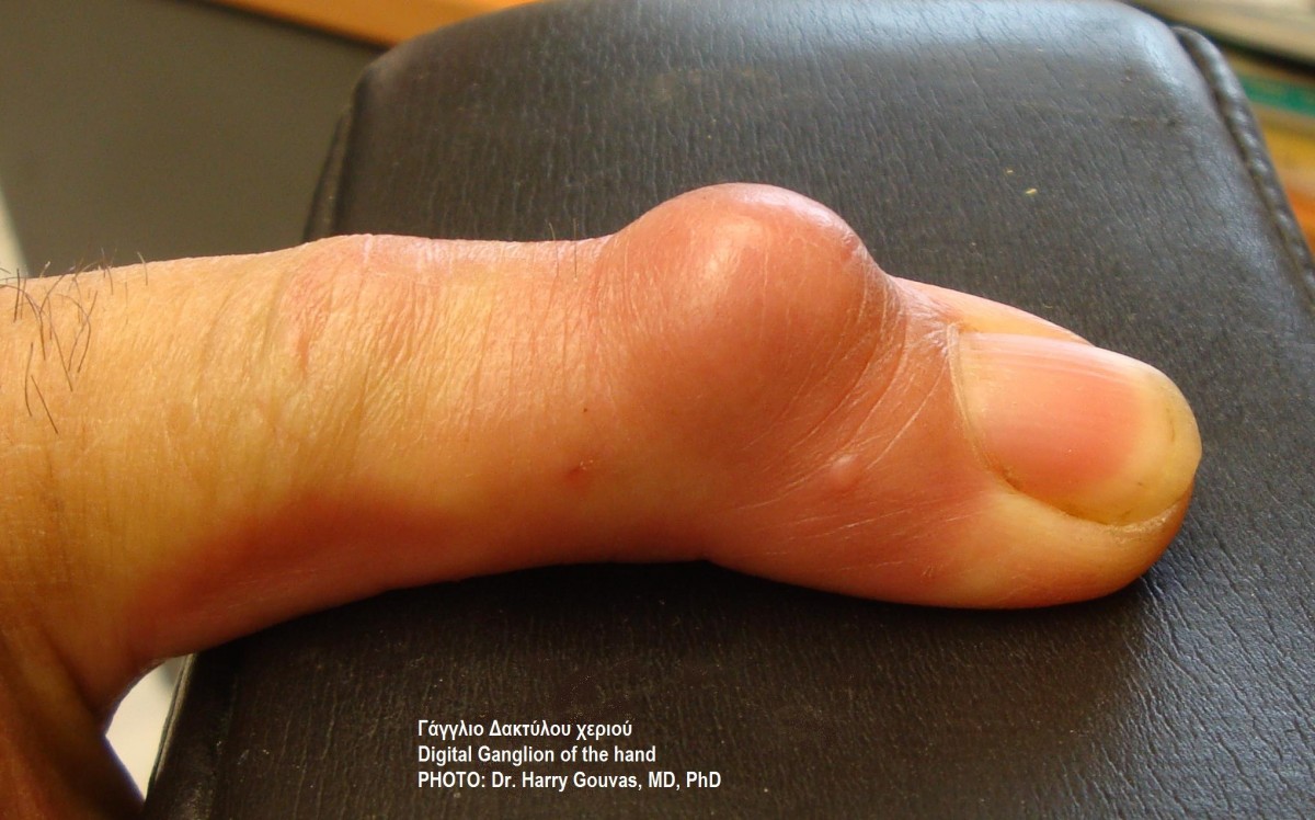 What to Do If You Have a Ganglion Cyst