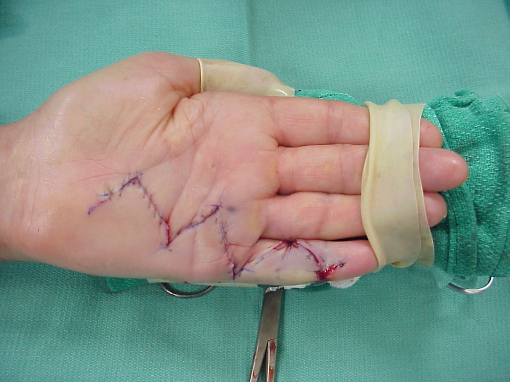 palm after dupuytren's disease surgery