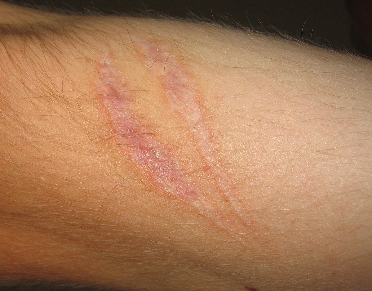 scar on a wrist
