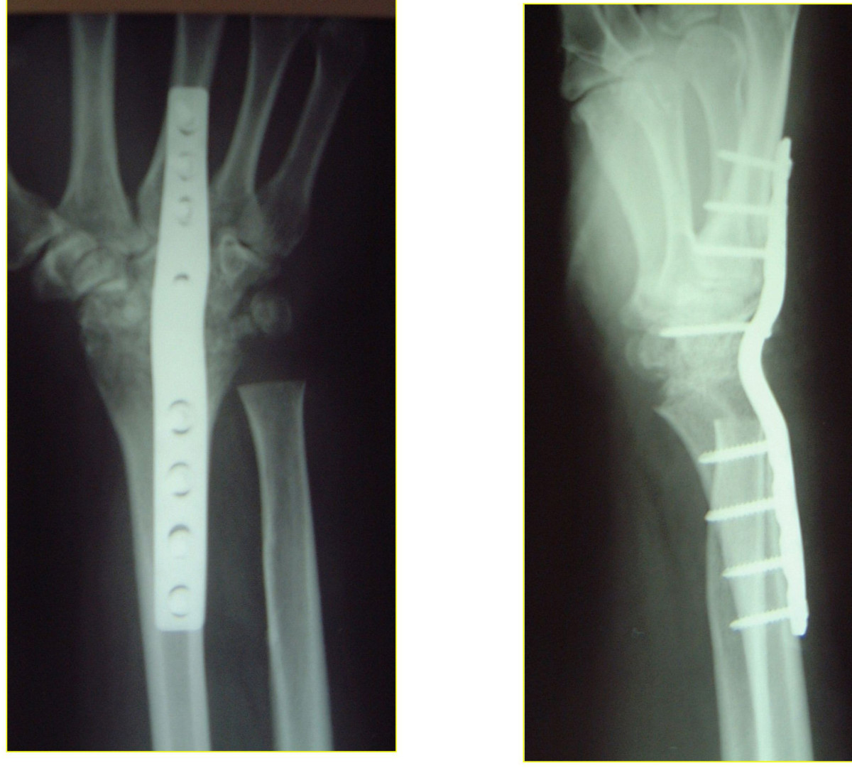 x ray of wrist fusion