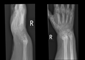 x-ray of wrist, Ladan Hajipour