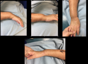 Deformity of wrist before surgery Ladan Hajipour