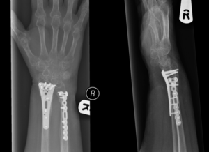 x ray results after surgery Ladan Hajpour