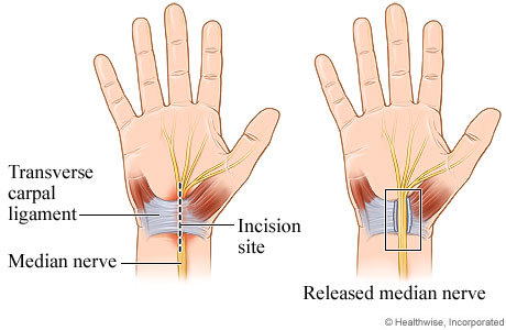 Day 5 of speedrunning carpal tunnel