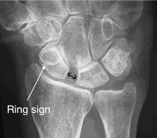 Scapholunate Ligament Tear xray