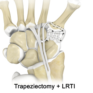 base of thumb arthritis graphic diagram, Ladan Hajipour