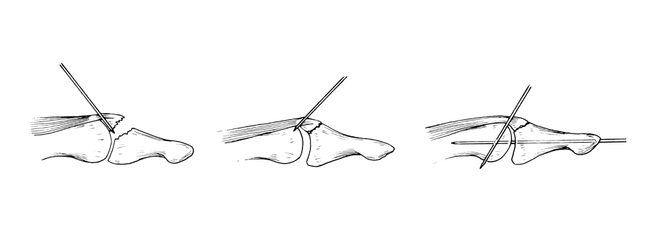diagram of mallet finger Ladan Hajipour