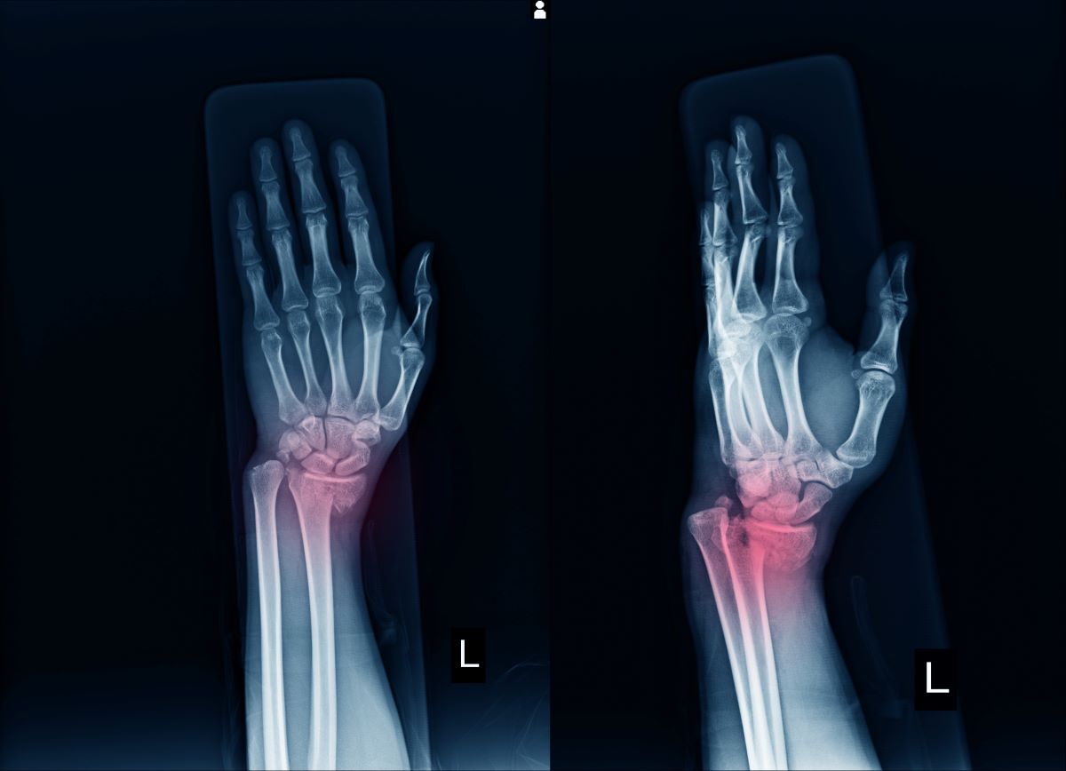 wrist fracture treatment