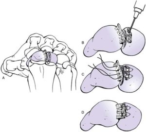 scapholunate ligament tear treatment