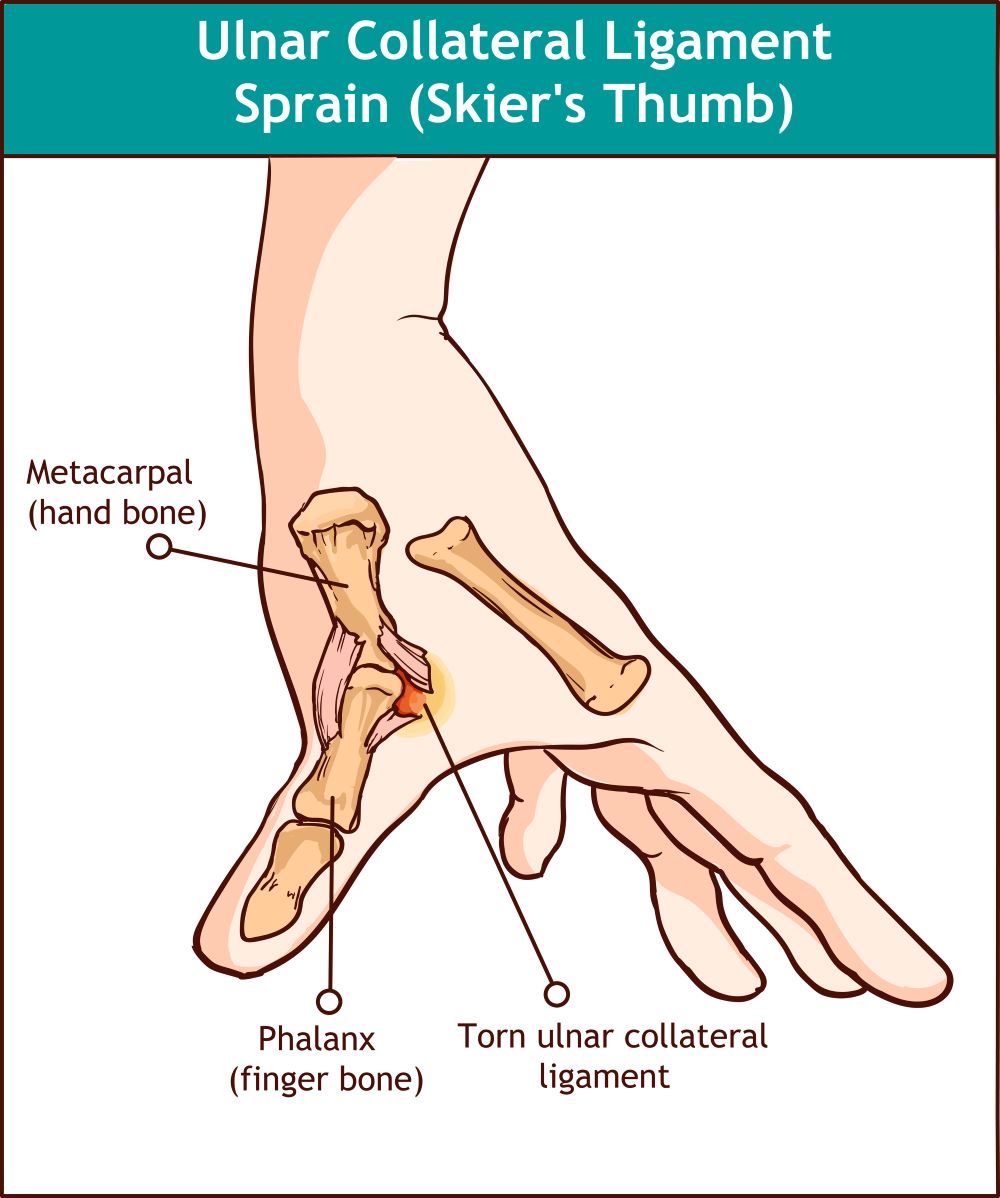 thumb ligament injury