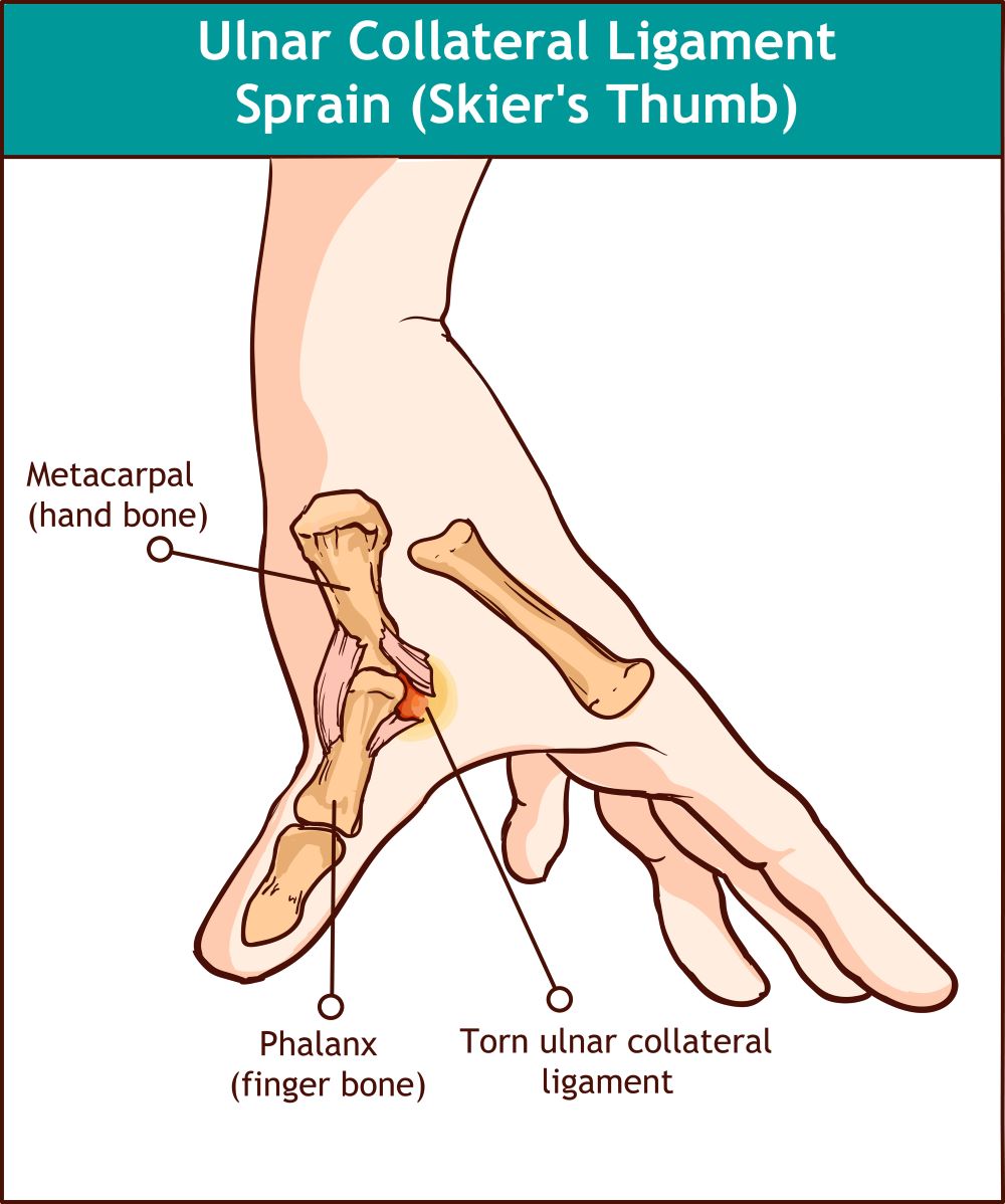 Thumb Ligament Injury Treatment Ladan Hajipour Manchester