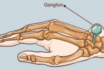 diagram of ganglion cysts