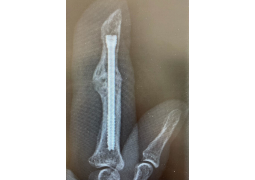 finger arthritis x ray