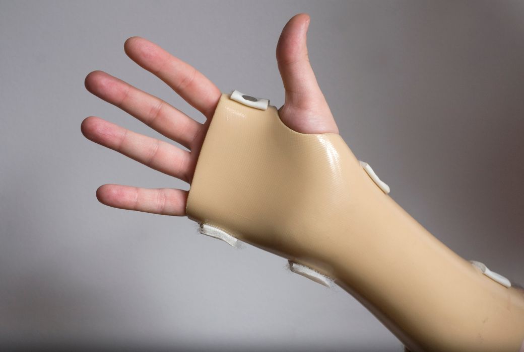 metacarpal fracture treatment