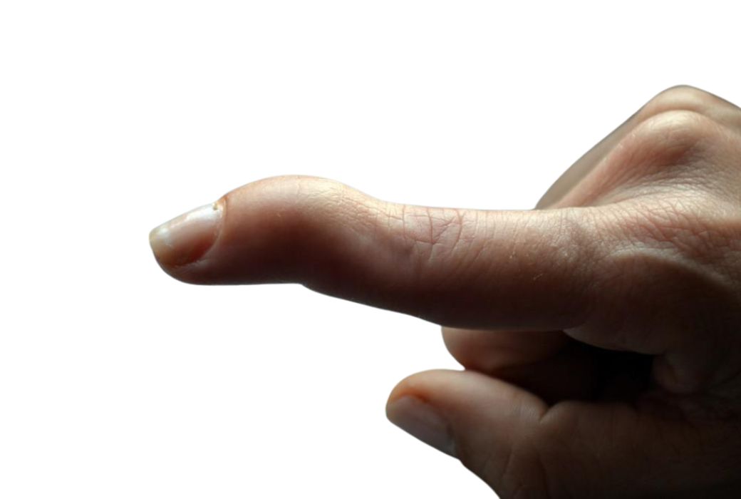 mallet finger treatment