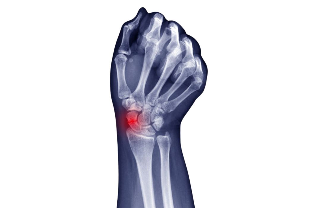 scaphoid fracture treatment