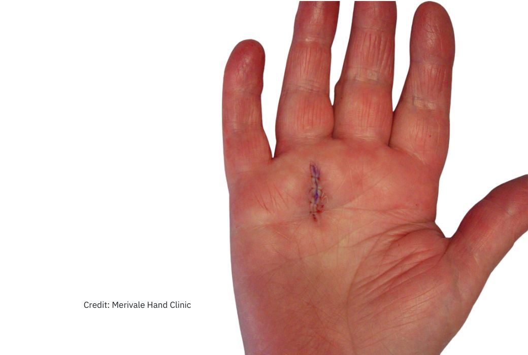 trigger-finger-ladan-hajipour-manchester-hand-wrist-surgery