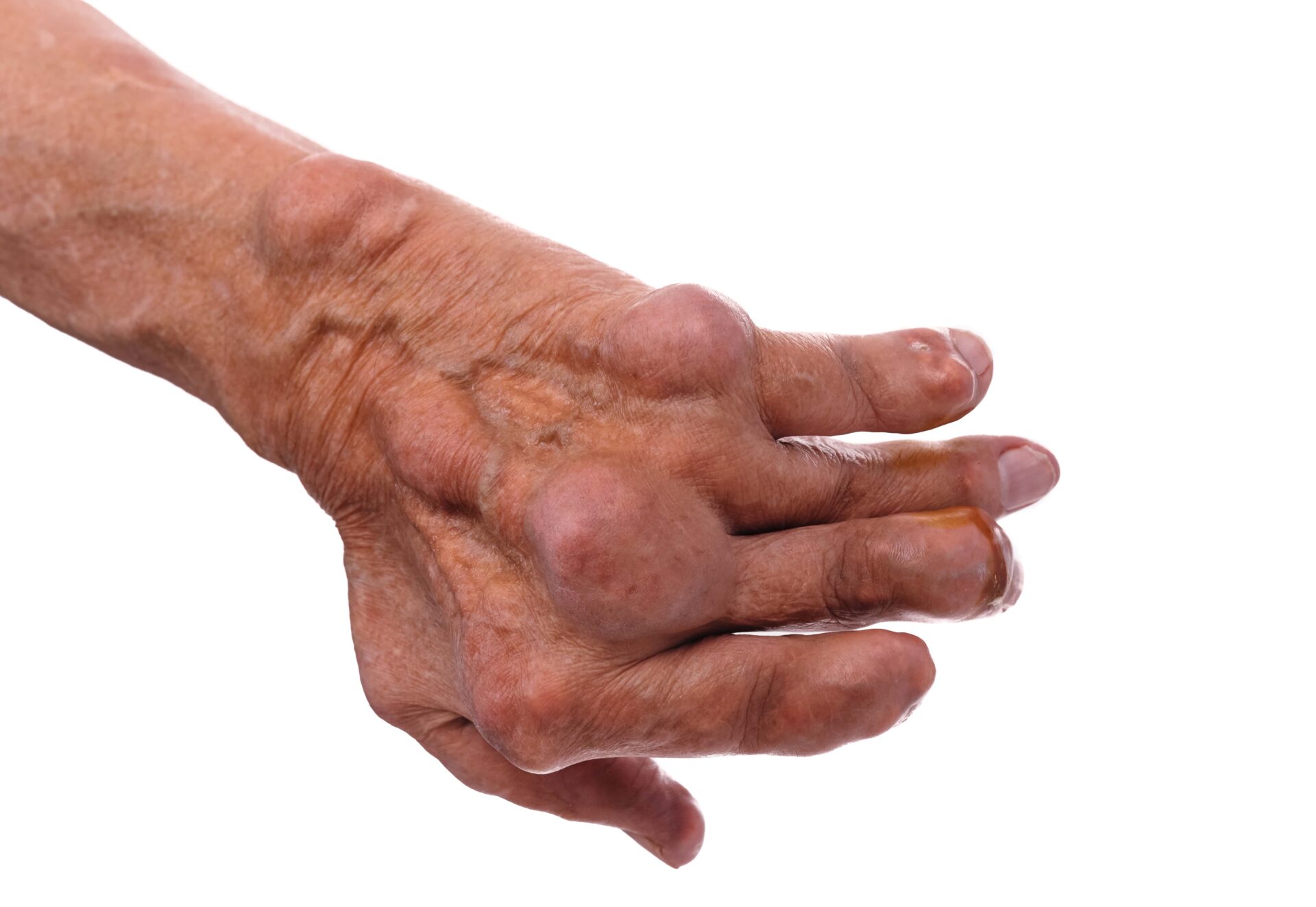 patient with gout in their hands Ladan Hajipour