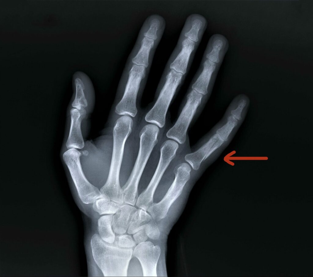 The different types of hand and wrist fractures Ladan Hajipour