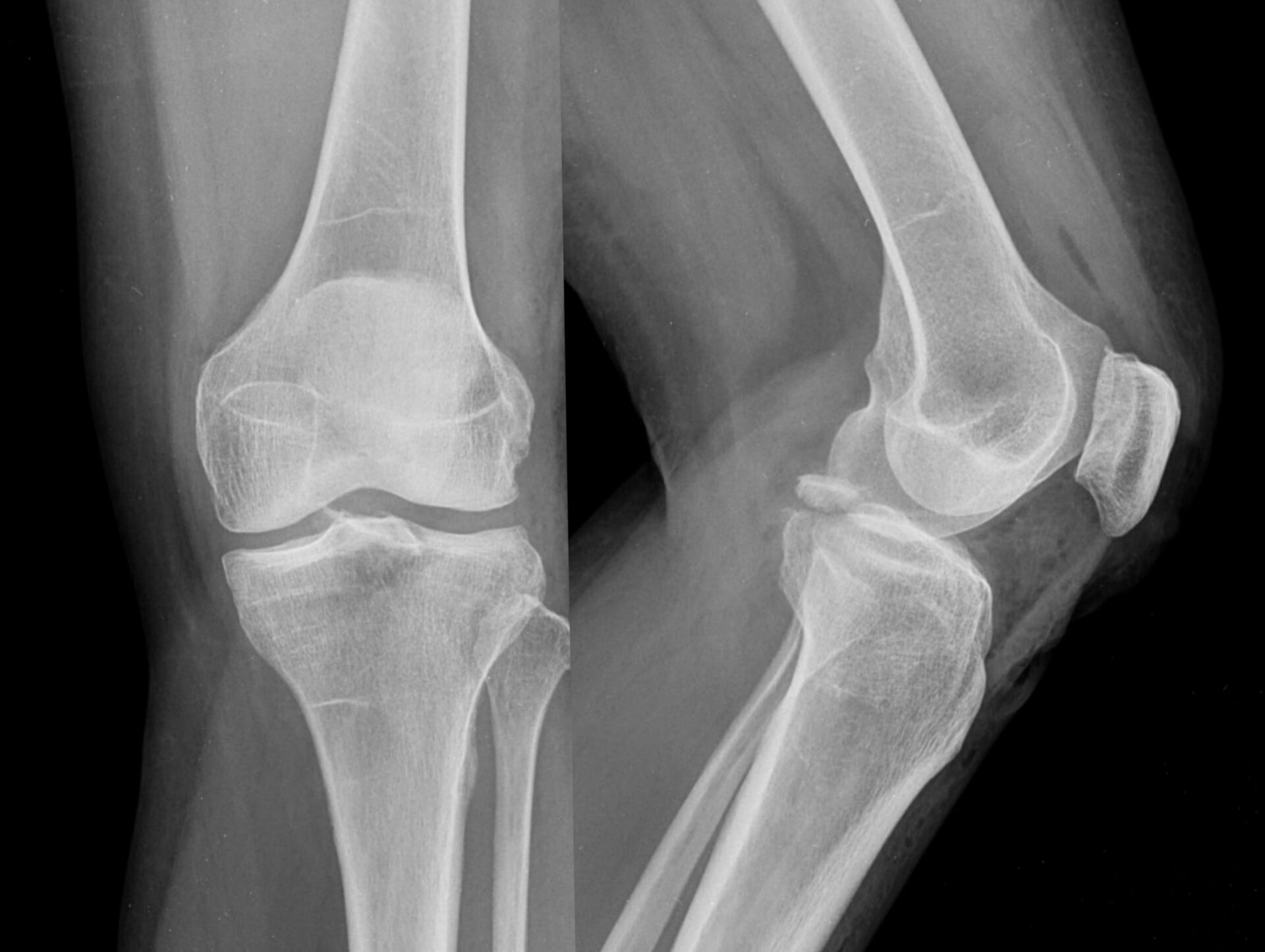 x ray of avulsion fracture Ladan Hajipour