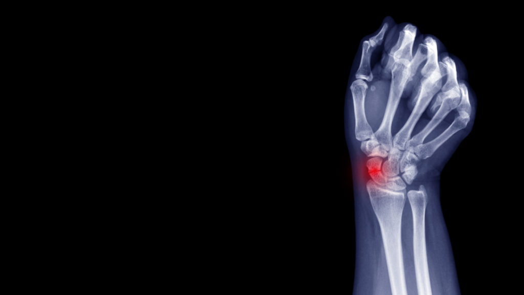 x-ray of a scaphoid fracture