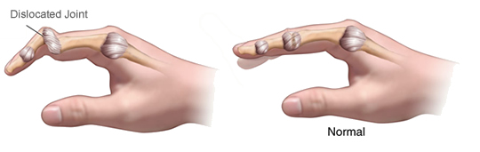 image depicting a normal finger and a dislocated finger