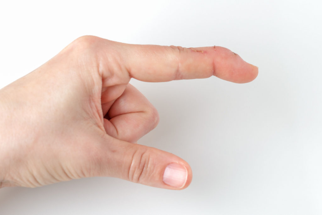 picture of a hand with mallet finger