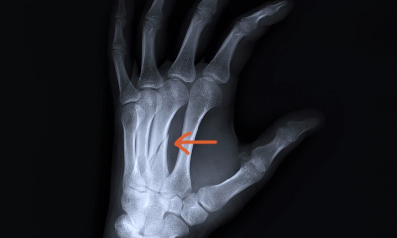 x-ray scan of a metacarpal fracture 