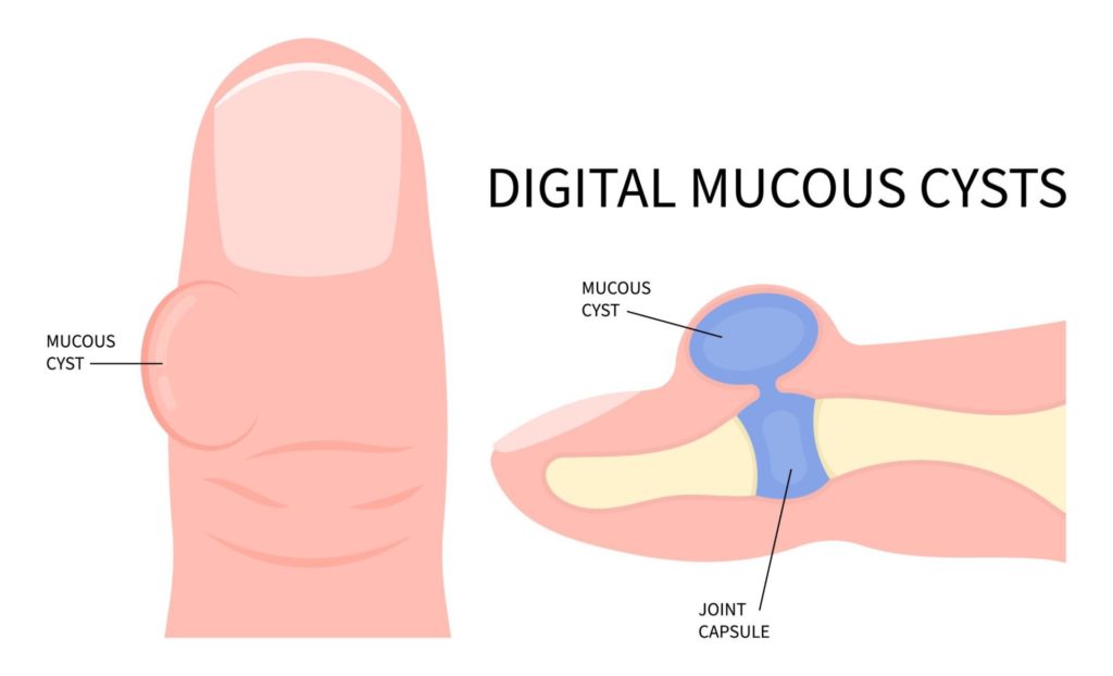 Diagram of a Digital Mucous Cyst