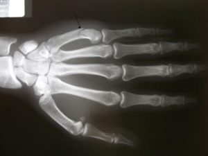 x-ray showing a boxing fracture to the pinkie finger.