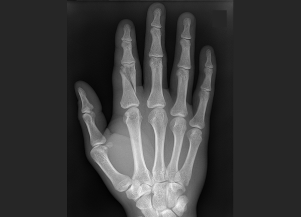 X-ray of a fractured finger