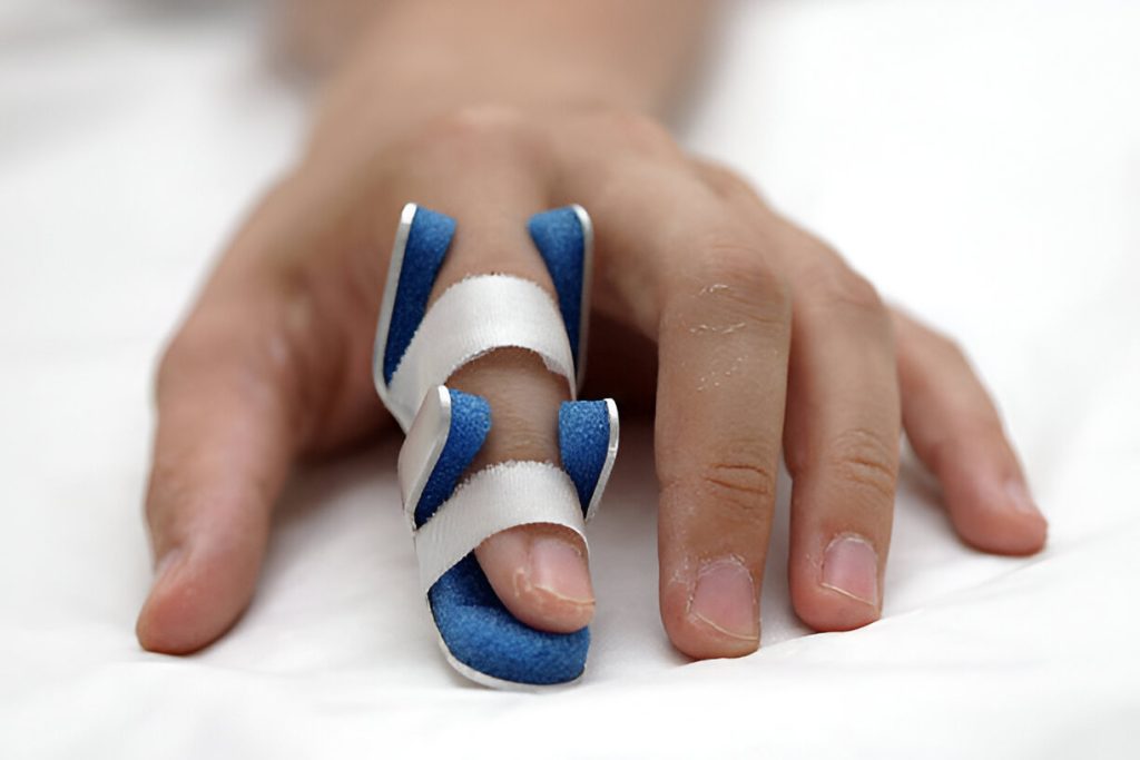 Finger cast in a splint