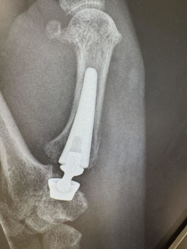 X-ray of thumb joint replacement.