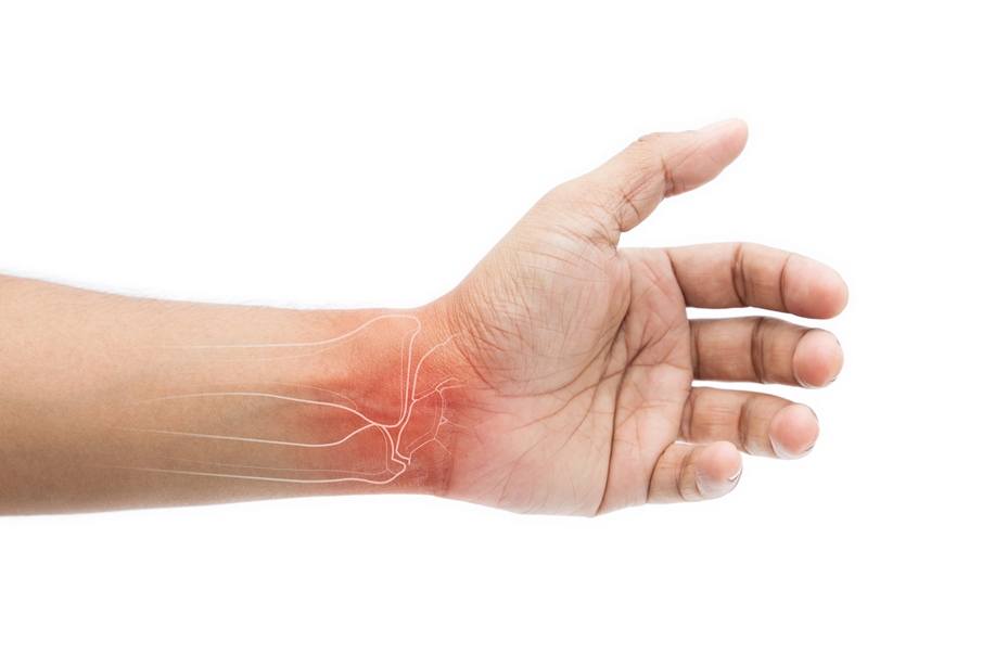 Stages of Carpal Tunnel Syndrome Explained