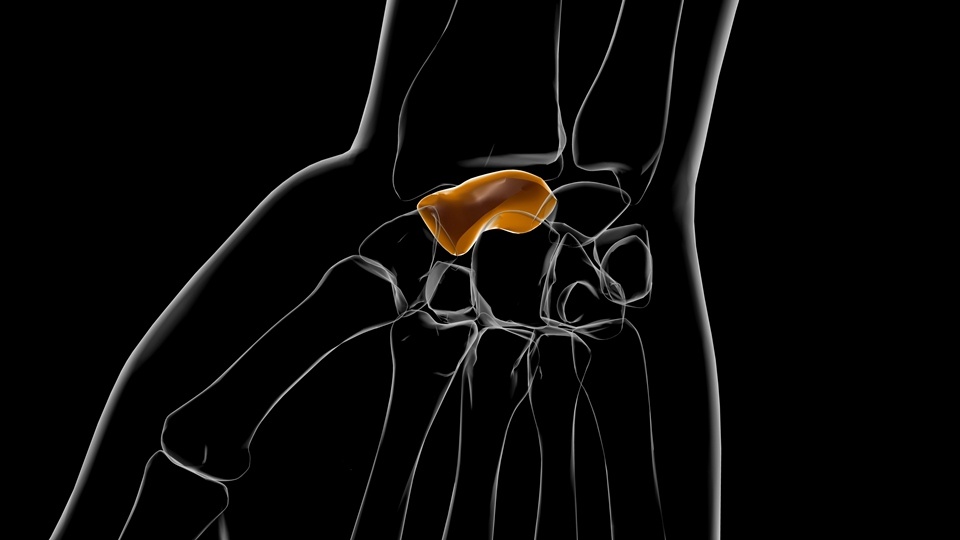 Schapoid Non-Union Explained