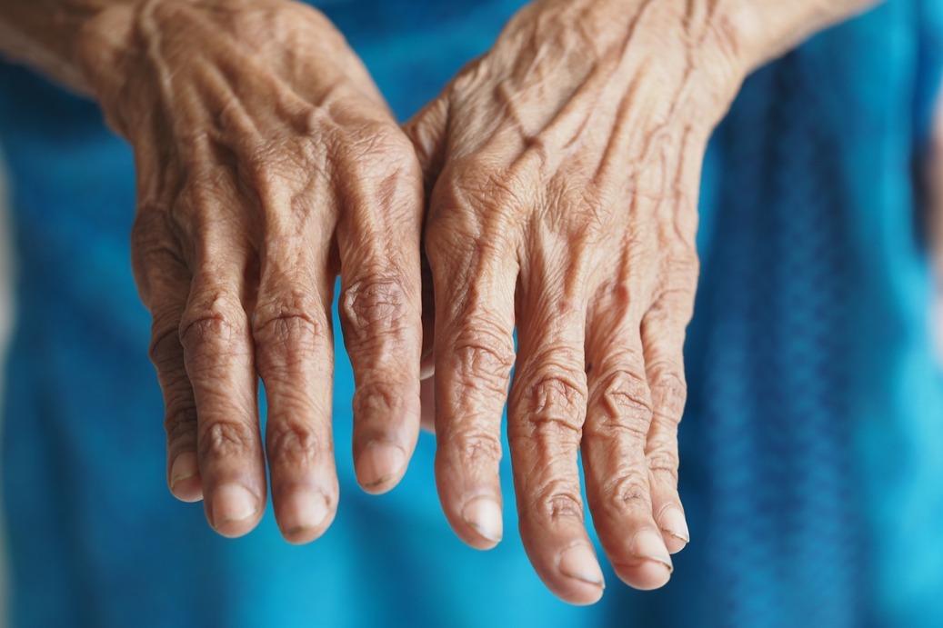 rheumatoid arthritis