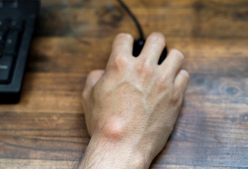 ganglion cyst treatment causes