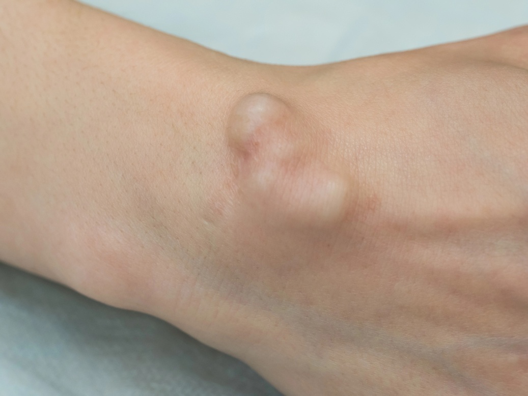 diagram of ganglion cysts