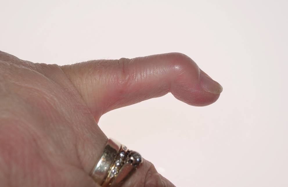 mallet finger treatment