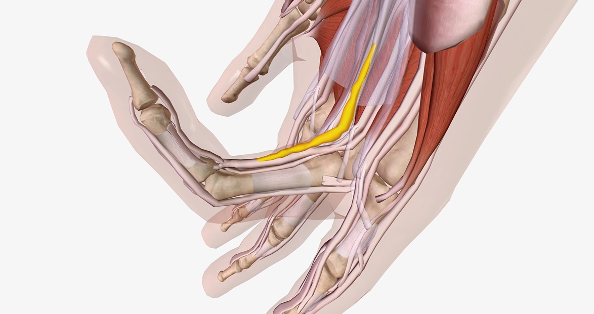 Hand showing early signs of Dupuytren's contracture, with a small lump in the palm and a finger beginning to bend inward.